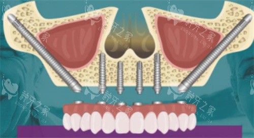 种植牙素材 种植牙素材