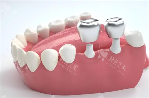 种植牙示意图片 种植牙示意图片