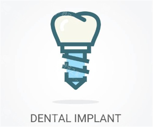种植牙线条示意图 种植牙线条示意图
