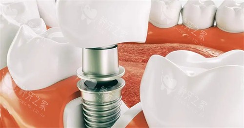 瑞典的诺贝尔种植牙多少钱一只?种植体优势全解析