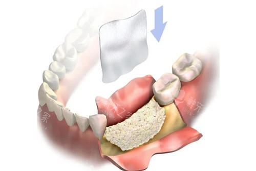 牙齿植骨示意图 牙齿植骨示意图