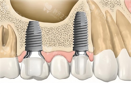 种植牙解剖图片 种植牙解剖图片
