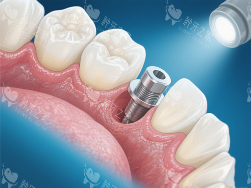种植牙手术示意图