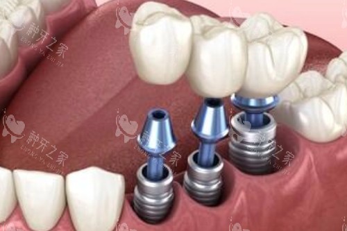 票选西安种植牙排行榜出炉!均是本地人认可种牙医院