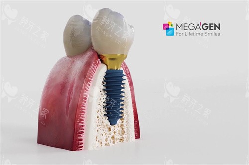 深圳万丰口腔医院种植牙怎么样？深测技术与实力！