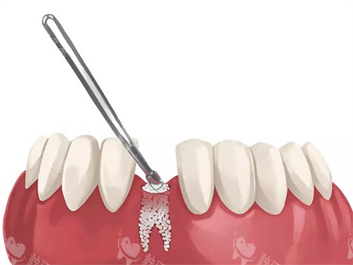 种植牙植骨的漫画图 种植牙植骨的漫画图