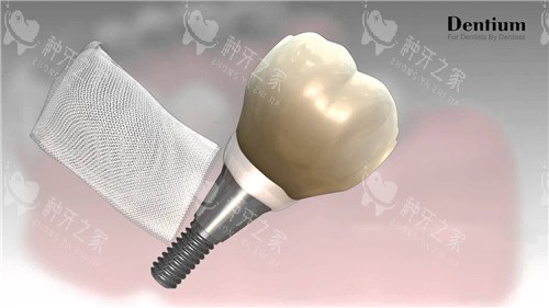 登腾种植牙和骨膜 登腾种植牙和骨膜