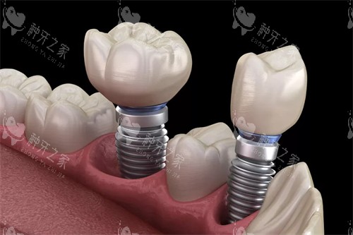 玉林牙博士口腔医院种牙1980元怎么样？种植技术好