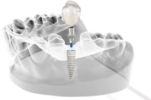 科特斯种植体植入图 科特斯种植体植入图