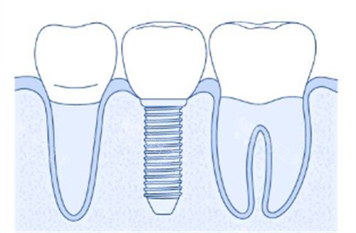美国安特高价格居中?对比奥齿泰冷作钛强度提升20%