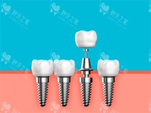 种植牙植体基台和牙冠漫画图 种植牙植体基台和牙冠漫画图
