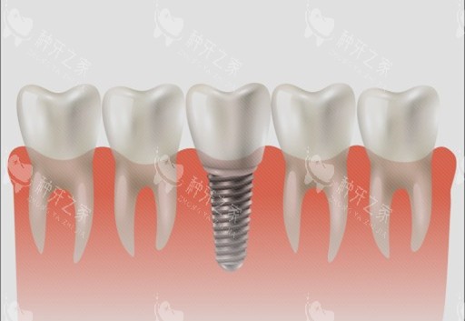 种植牙单颗漫画示意图 种植牙单颗漫画示意图
