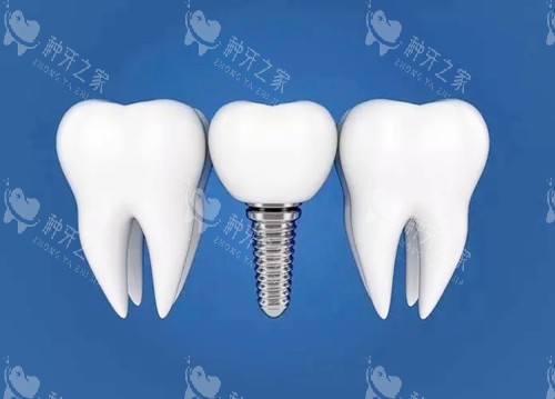 种植牙卡通图 种植牙卡通图