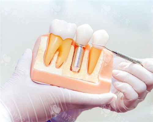 东莞种植牙多少钱？25年新价目：单颗1980起
