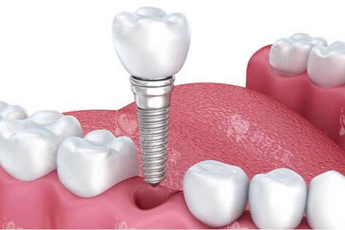 种植牙植入图 种植牙植入图