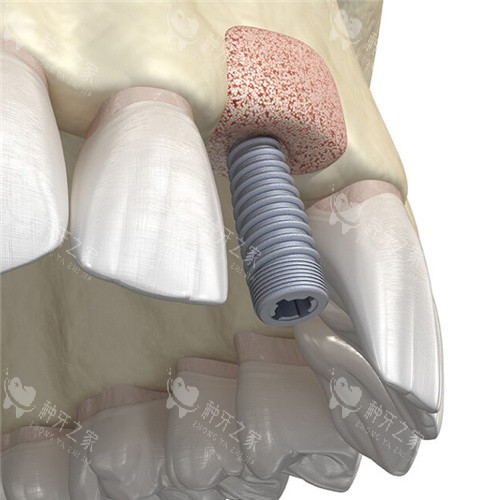 种植牙植骨 种植牙植骨