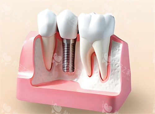 种植牙模型解剖展示 种植牙模型解剖展示