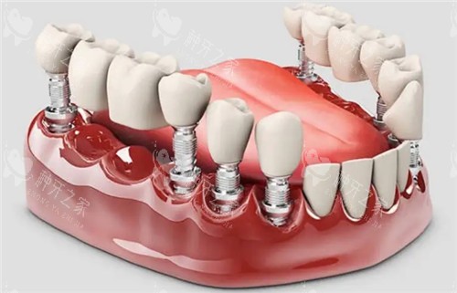 种植牙后能正常咀嚼吗？修养期这些硬货食物千万别碰