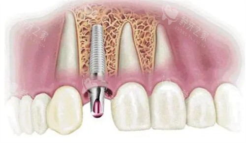 种植牙动画模拟图 种植牙动画模拟图