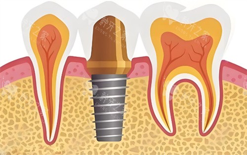 种植牙展示图片展示图