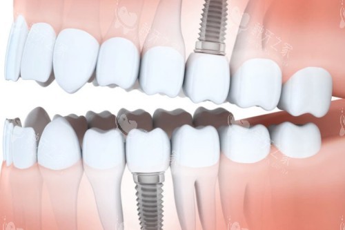 种植牙植入口腔图解