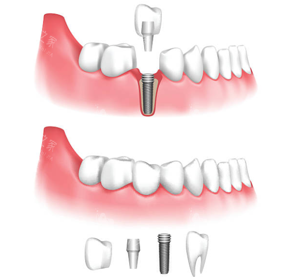 种植牙拆分示意图 种植牙拆分示意图