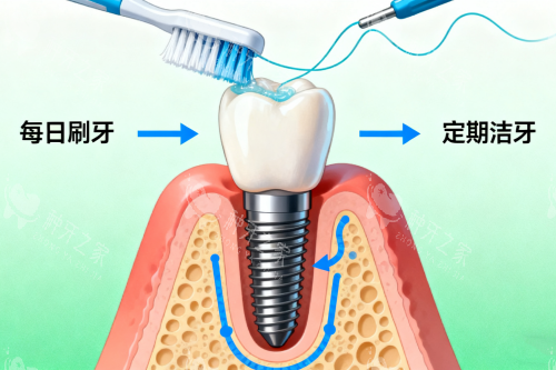 清洁种植牙卡通图 清洁种植牙卡通图