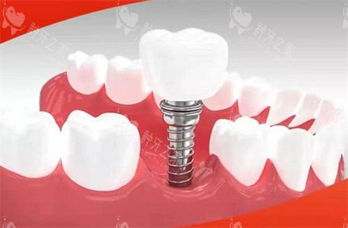 赣州金铂利口腔种植牙 赣州金铂利口腔种植牙