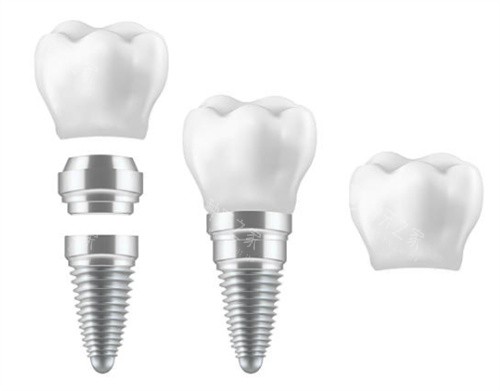 开封种牙多少钱一个？2600到1.5万起品牌差太多