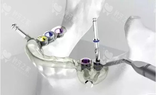 种植牙手术全程多长时间？术前/植入/骨结合耗时公开