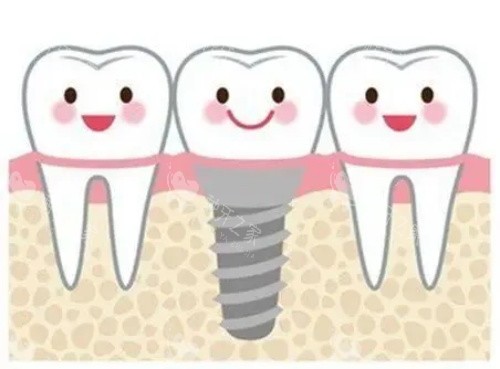 种牙的示意图 种牙的示意图