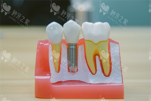 牙科种植牙模型