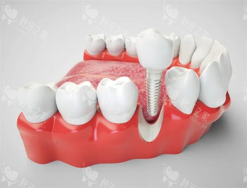 单颗种植牙展示 单颗种植牙展示