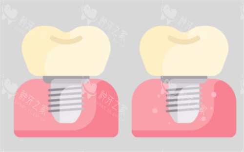 种植牙对比图