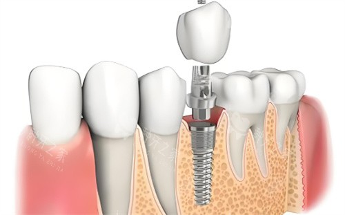 成都种牙多少钱？韩国品牌5000-8000元