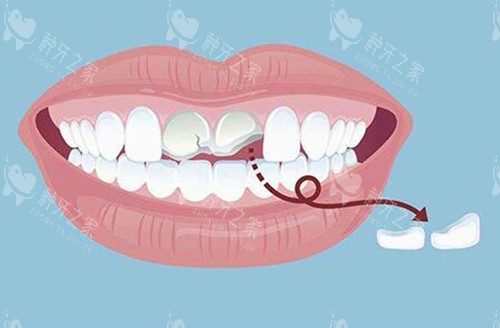 门牙修复选冠还是种植?优缺点对比+医生建议