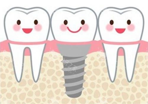 呼和浩特天牙口腔种植牙怎么样？数智化种牙更放心！