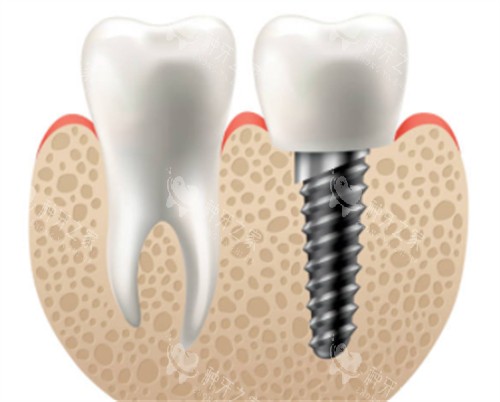 天津种植牙品牌价格大比拼:国产2千8元起