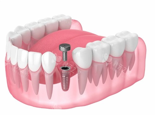 石家庄种植牙哪个医院比较好?剖析5家技术流医院