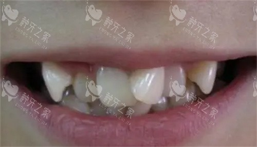 牙齿拥挤的照片