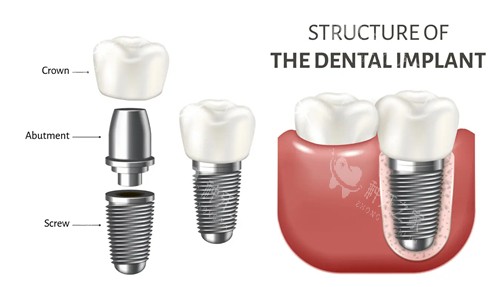 广州花都区经典口腔种植牙靠谱吗?技术价格服务全解析