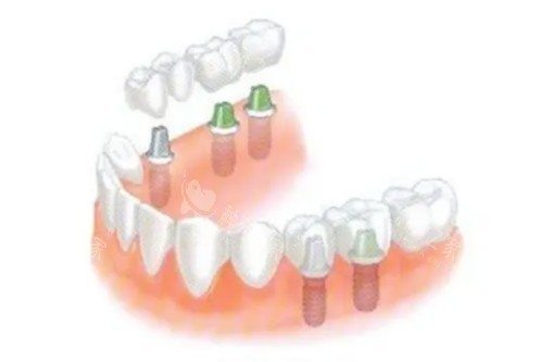 globalD种植牙怎么样？坚固耐用性价比绝了！