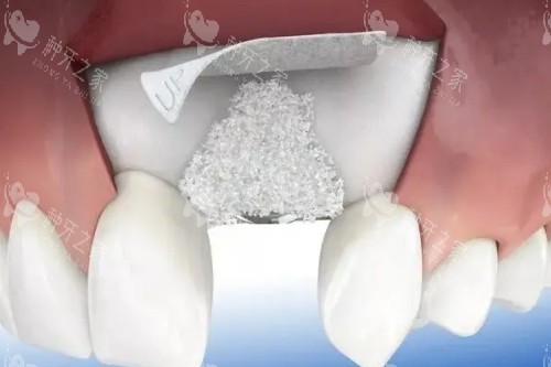 深圳马泷齿科25年种牙价格表及胡艺博医生技术口碑