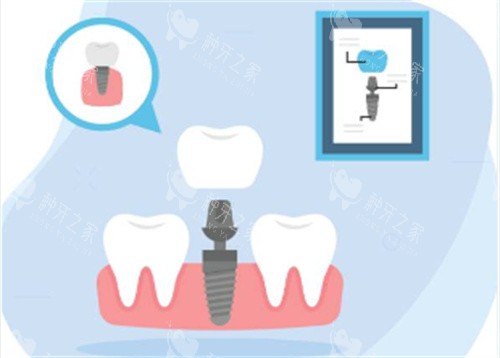 种植牙种植过程