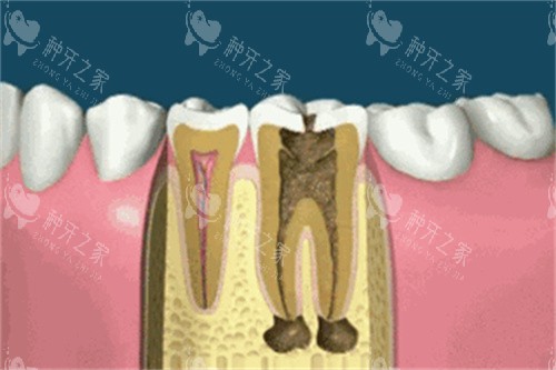 种植牙卡通展示图