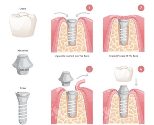 种植牙过程图 种植牙过程图