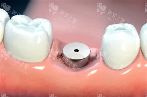 种植牙品牌选择:为何进口品牌更受青睐?