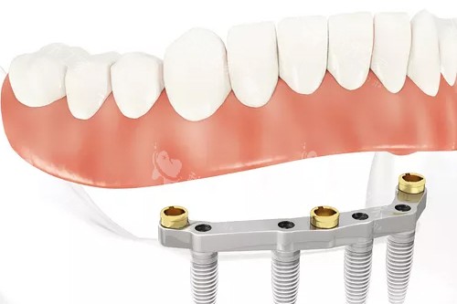 种牙植骨粉后多久消肿?医师解答,助你快速改善!