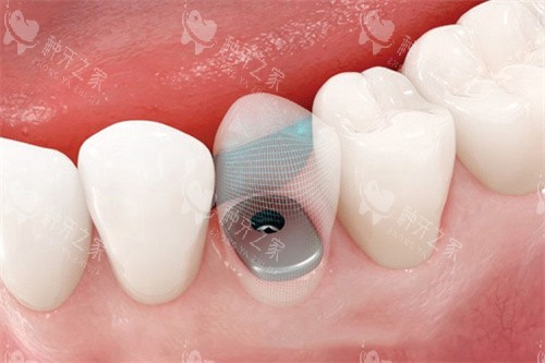 2025舟山种植牙价格详解：含国产/进口种植牙费用