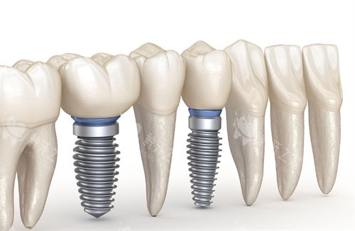 种植牙动画图片展示